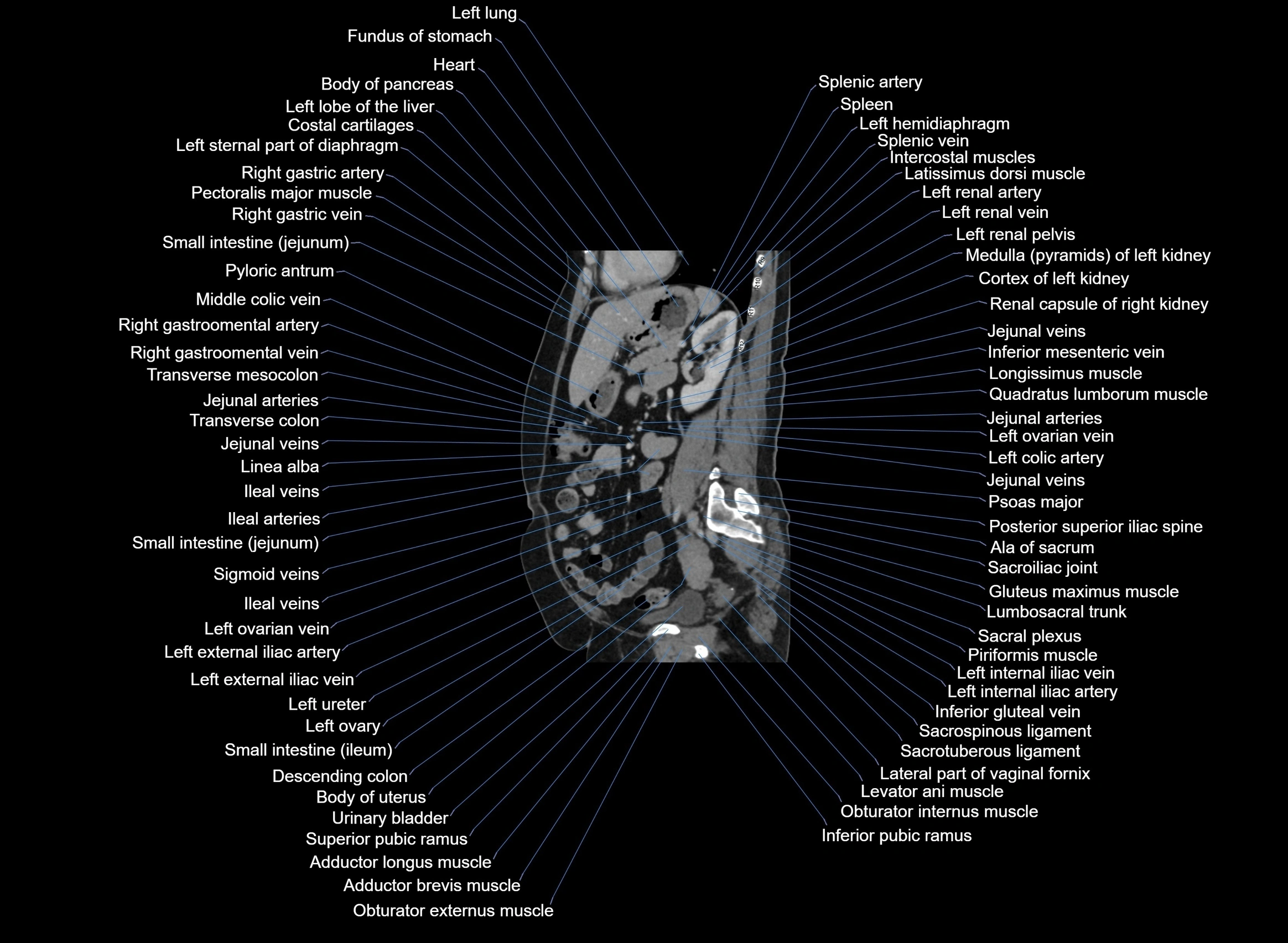 CT Abdomen sagittal cross sectional anatomy labelled radiology image -00046.webp